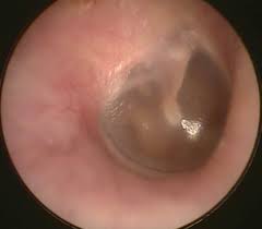normal ear canal